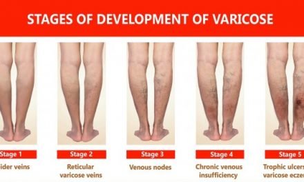 AURSES HEALTHCARE OFFERS INNOVATIVE METHODS TO TREAT VARICOSE VEINS