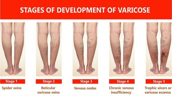 AURSES HEALTHCARE OFFERS INNOVATIVE METHODS TO TREAT VARICOSE VEINS